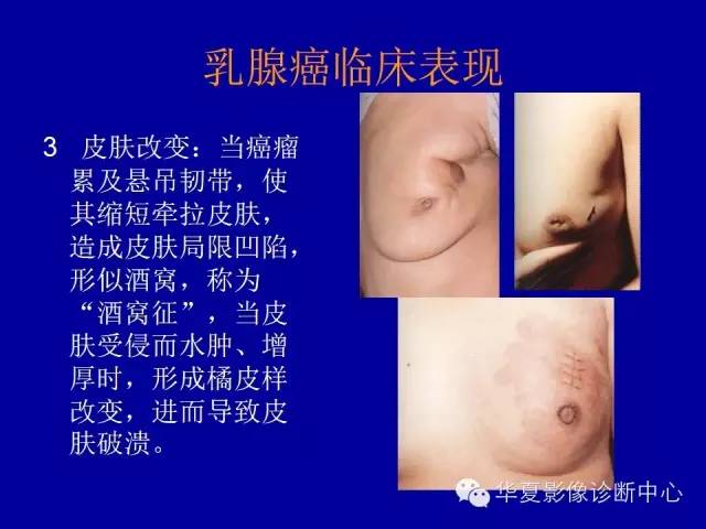 【PPT】乳腺癌的X线诊断