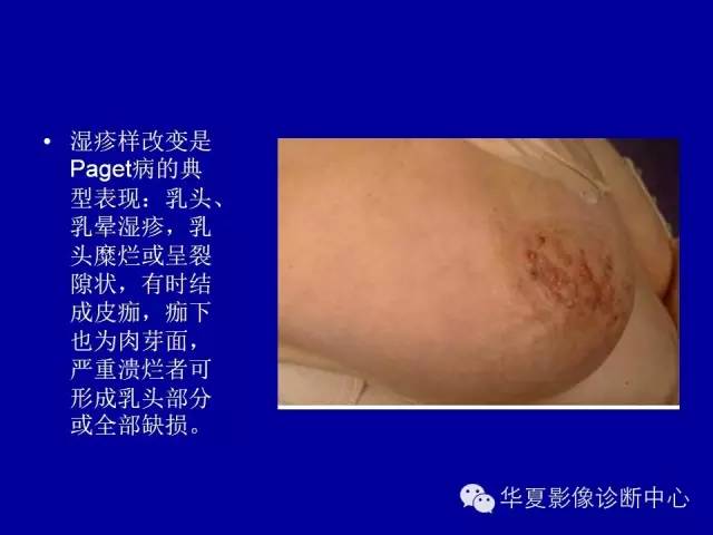【PPT】乳腺癌的X线诊断