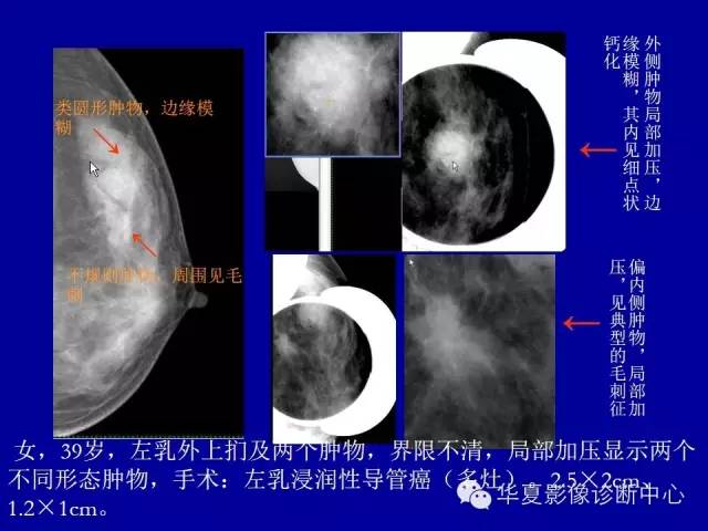 【PPT】乳腺癌的X线诊断