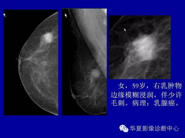 【PPT】乳腺癌的X线诊断