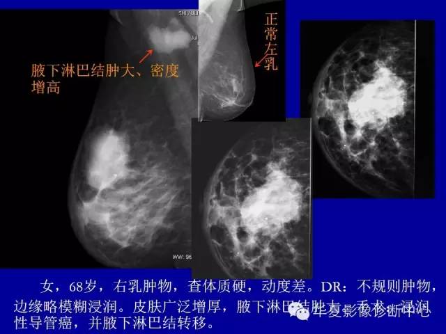 【PPT】乳腺癌的X线诊断