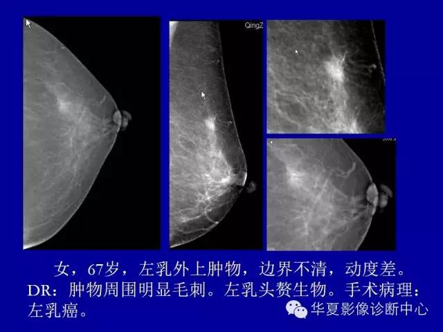 【PPT】乳腺癌的X线诊断
