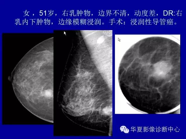 【PPT】乳腺癌的X线诊断