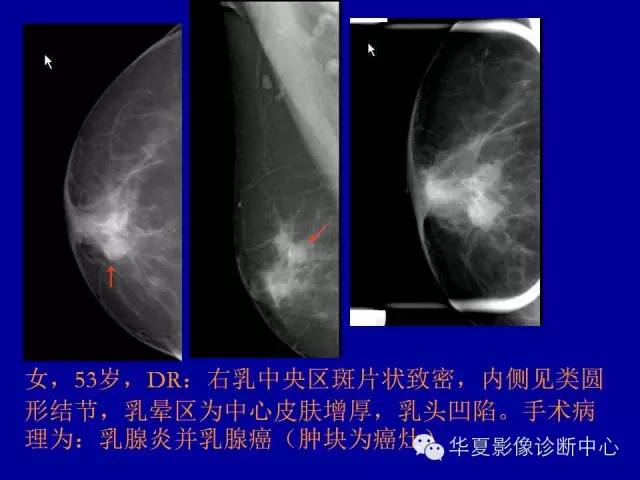 【PPT】乳腺癌的X线诊断