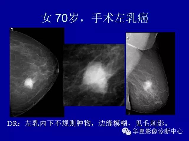 【PPT】乳腺癌的X线诊断