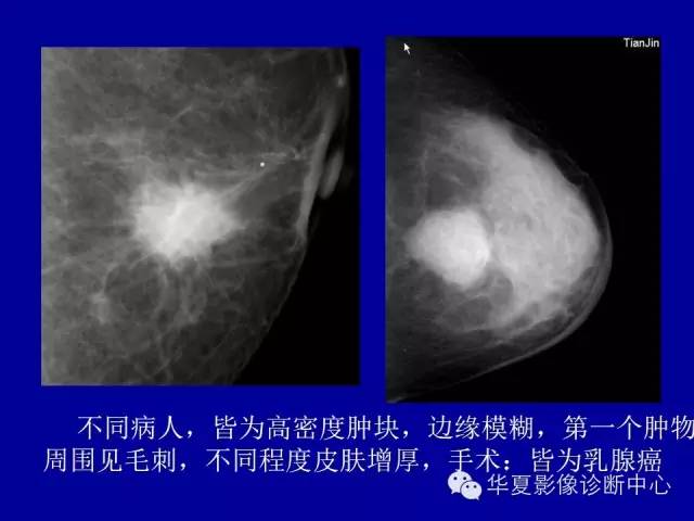 【PPT】乳腺癌的X线诊断