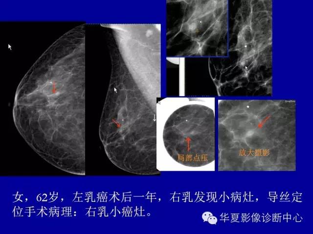 【PPT】乳腺癌的X线诊断