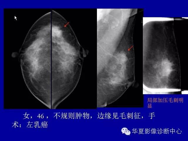 【PPT】乳腺癌的X线诊断