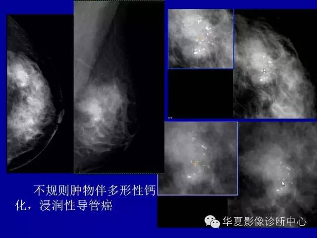 【PPT】乳腺癌的X线诊断