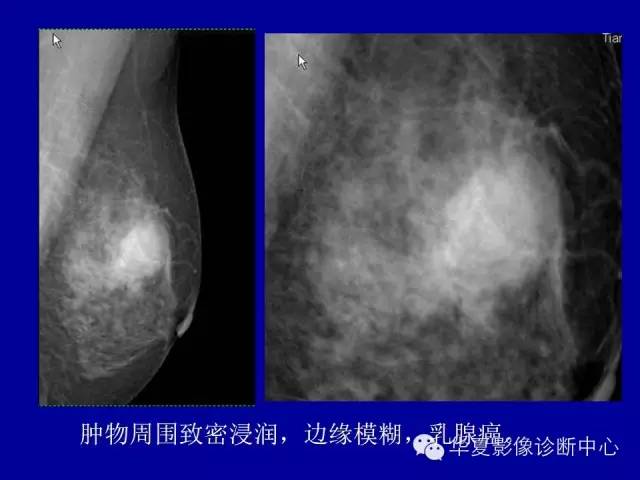 【PPT】乳腺癌的X线诊断