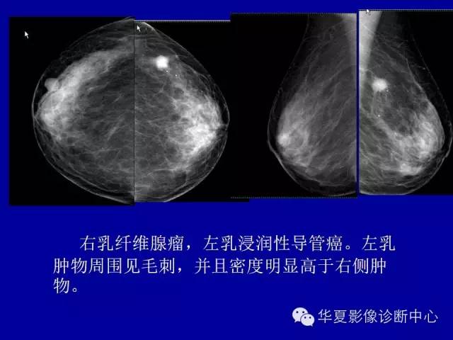 【PPT】乳腺癌的X线诊断