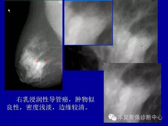 【PPT】乳腺癌的X线诊断