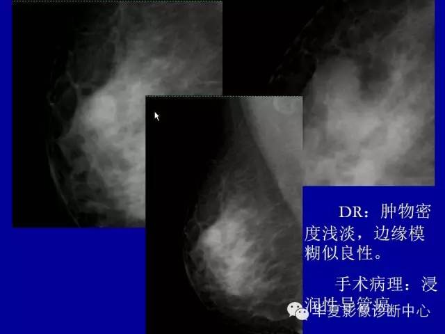 【PPT】乳腺癌的X线诊断
