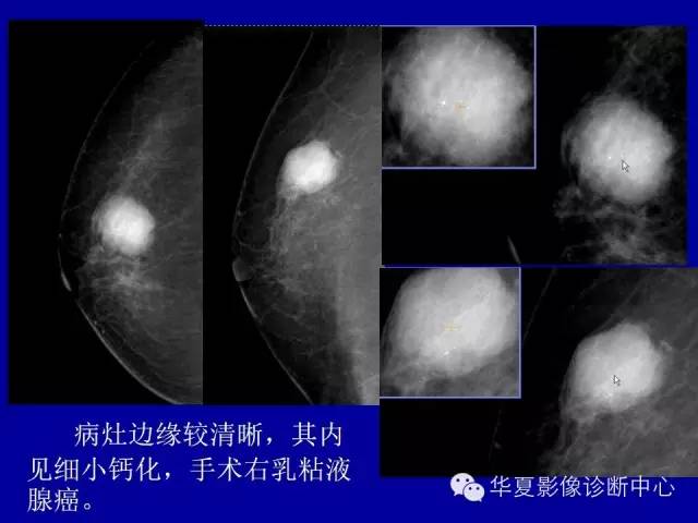 【PPT】乳腺癌的X线诊断
