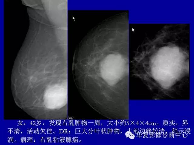 【PPT】乳腺癌的X线诊断