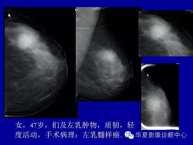 【PPT】乳腺癌的X线诊断