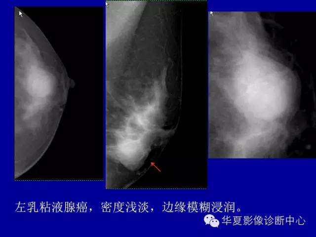 【PPT】乳腺癌的X线诊断