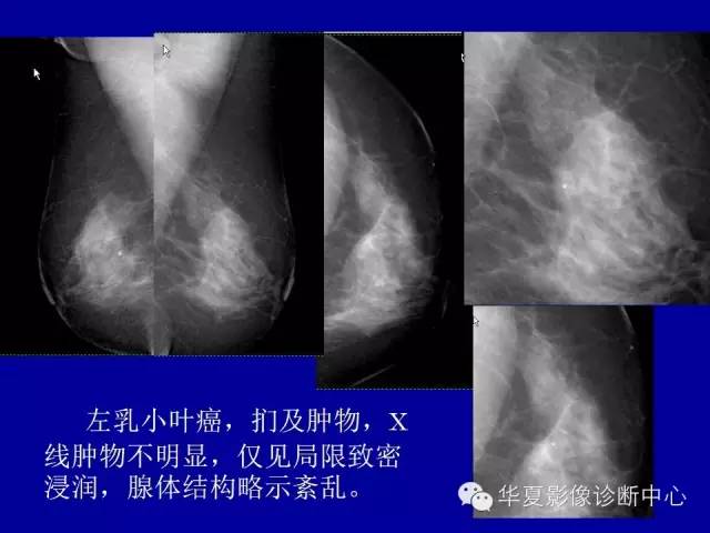 【PPT】乳腺癌的X线诊断