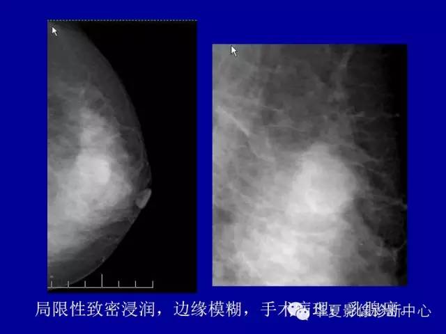 【PPT】乳腺癌的X线诊断