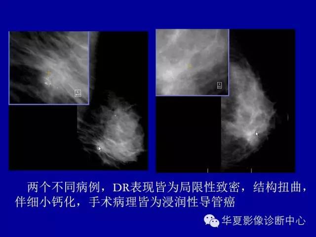【PPT】乳腺癌的X线诊断