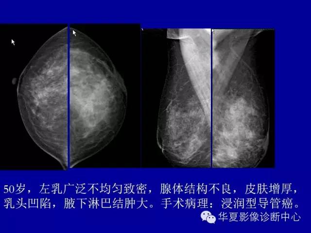 【PPT】乳腺癌的X线诊断