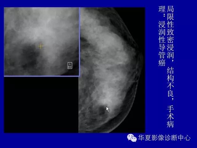 【PPT】乳腺癌的X线诊断