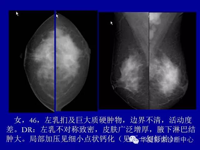【PPT】乳腺癌的X线诊断