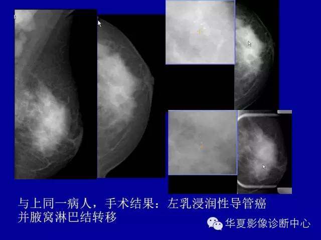 【PPT】乳腺癌的X线诊断