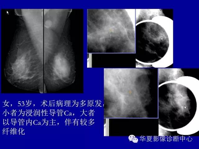 【PPT】乳腺癌的X线诊断