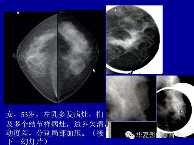 【PPT】乳腺癌的X线诊断