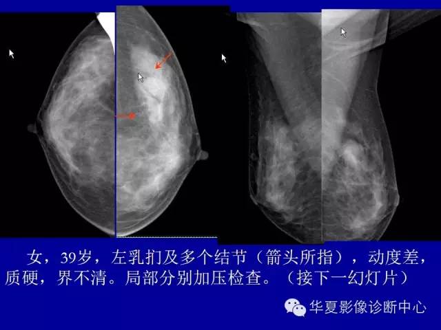 【PPT】乳腺癌的X线诊断