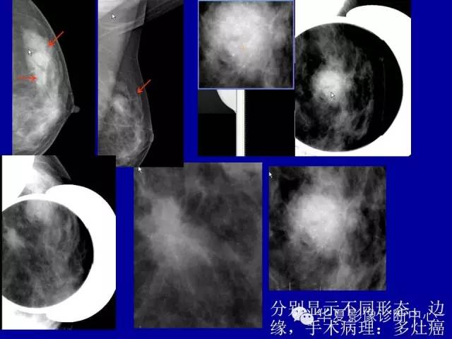 【PPT】乳腺癌的X线诊断