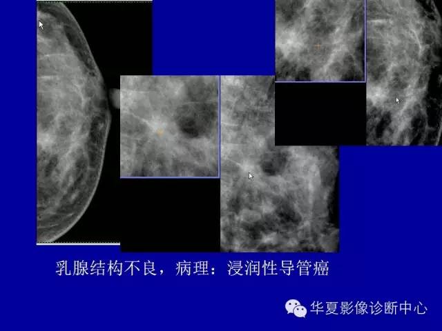 【PPT】乳腺癌的X线诊断