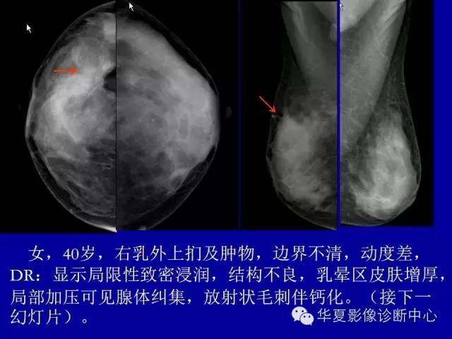 【PPT】乳腺癌的X线诊断