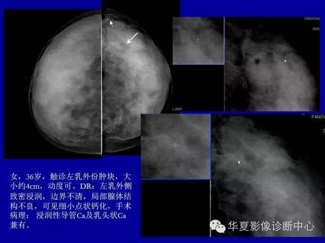 【PPT】乳腺癌的X线诊断