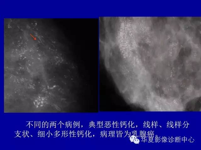 【PPT】乳腺癌的X线诊断
