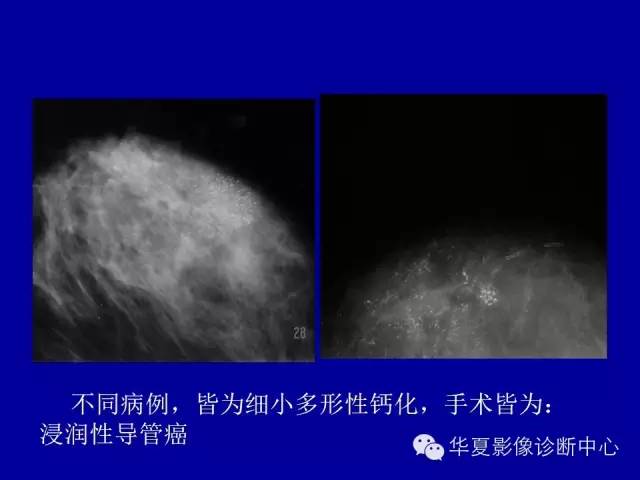 【PPT】乳腺癌的X线诊断