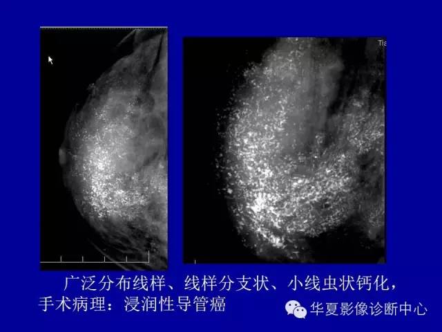 【PPT】乳腺癌的X线诊断
