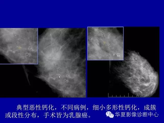 【PPT】乳腺癌的X线诊断