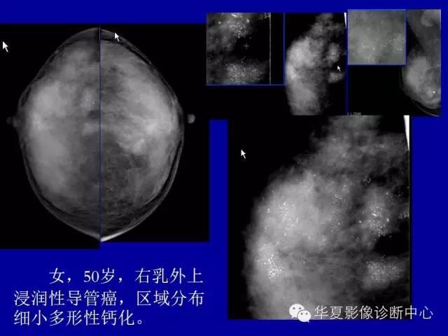 【PPT】乳腺癌的X线诊断