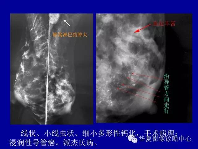 【PPT】乳腺癌的X线诊断
