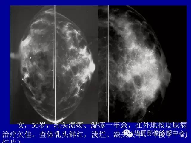 【PPT】乳腺癌的X线诊断