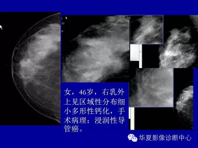 【PPT】乳腺癌的X线诊断