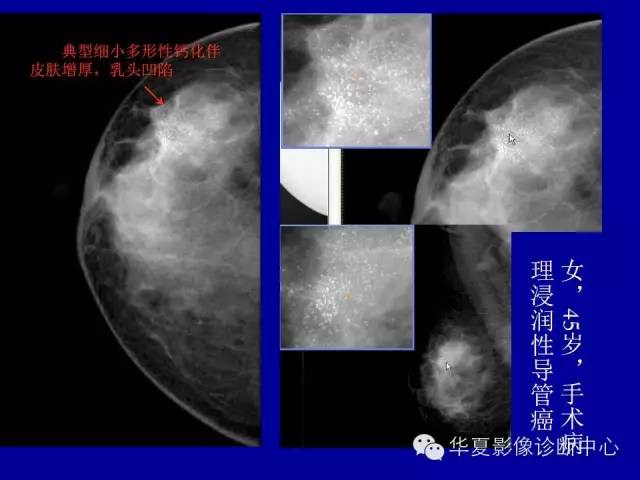 【PPT】乳腺癌的X线诊断