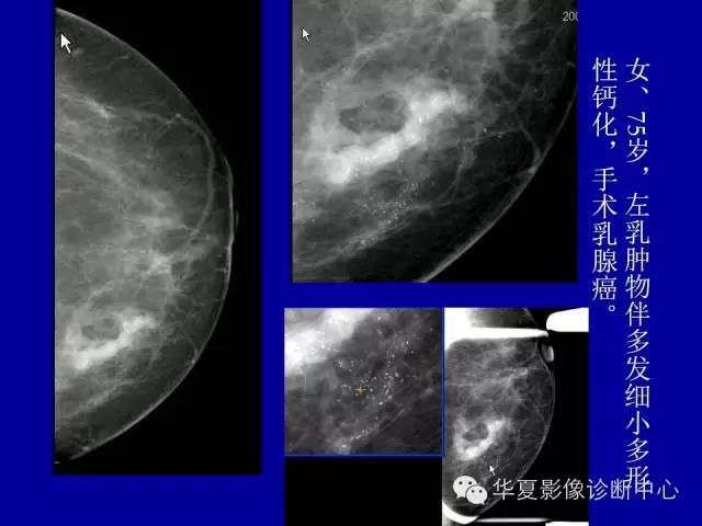 【PPT】乳腺癌的X线诊断