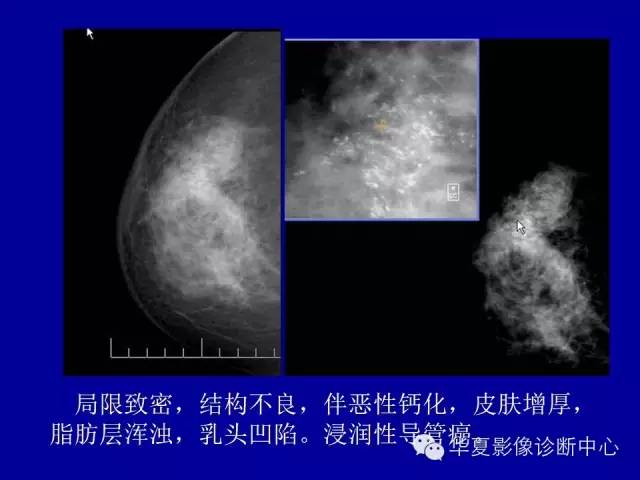 【PPT】乳腺癌的X线诊断