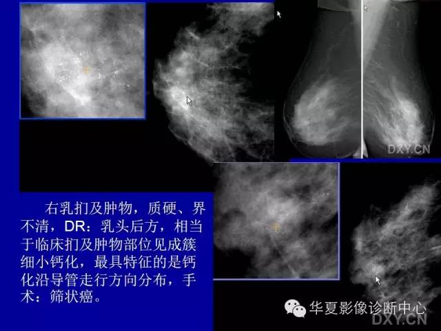 【PPT】乳腺癌的X线诊断