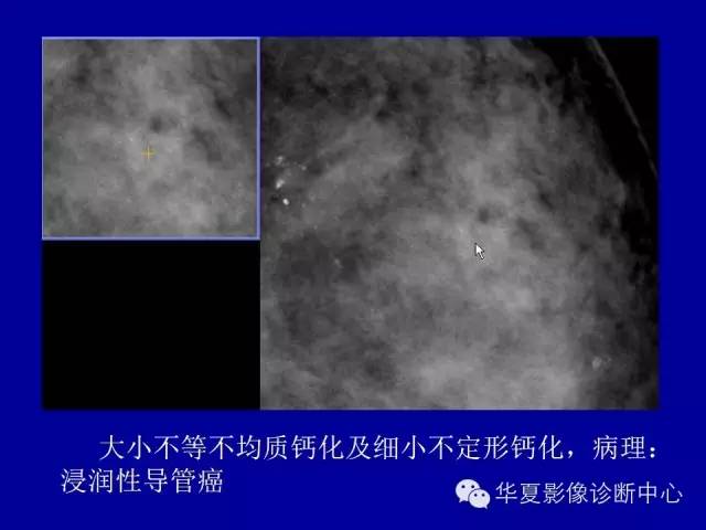 【PPT】乳腺癌的X线诊断