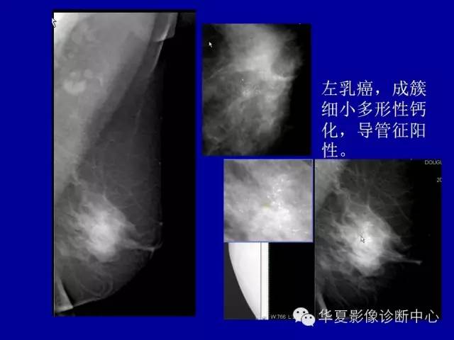 【PPT】乳腺癌的X线诊断