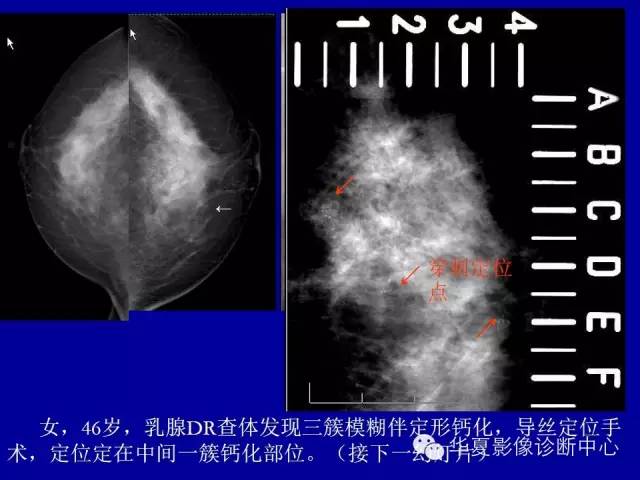 【PPT】乳腺癌的X线诊断